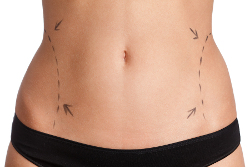 Liposuction surgery Liposuction surgery
